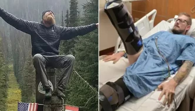 Aventureiro tem pernas amputadas após queimadura no polegar; entenda