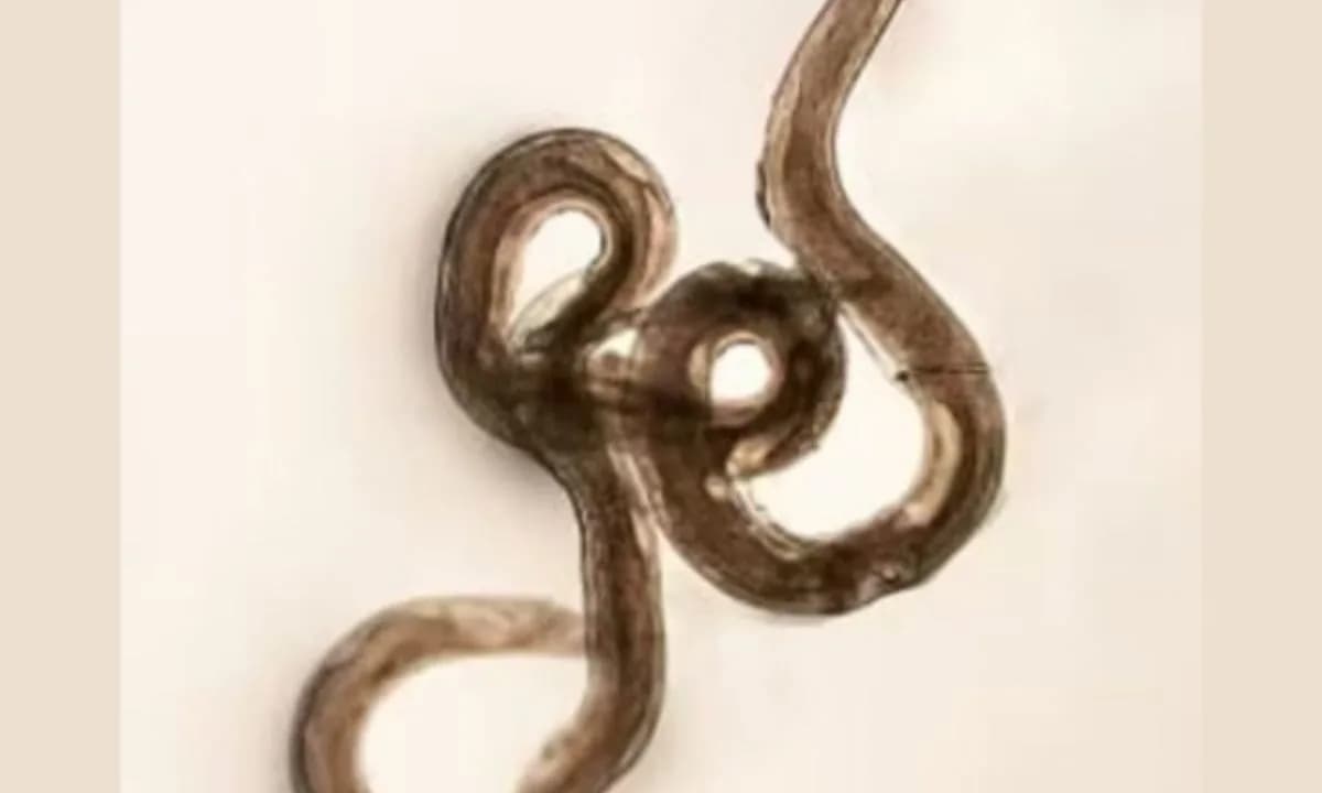 Mulher descobre ter vermes parasistas do cérebro após voltar de férias