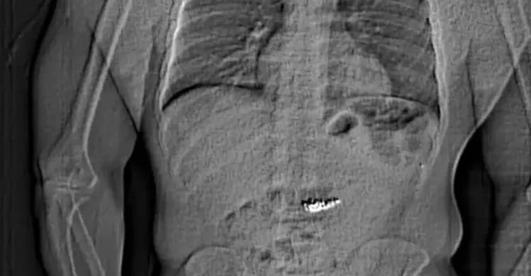 Suspeito engole joias avaliada em milhões após roubo em Orlando