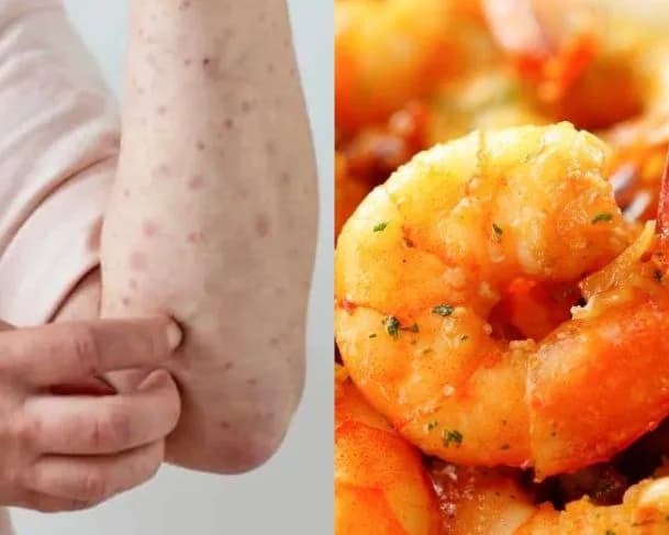 Você tem alergia a frutos do mar? Saiba agora quais os motivos