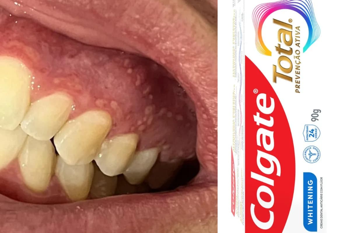 Anvisa interdita creme dental da Colgate por efeitos colaterais em clientes; entenda