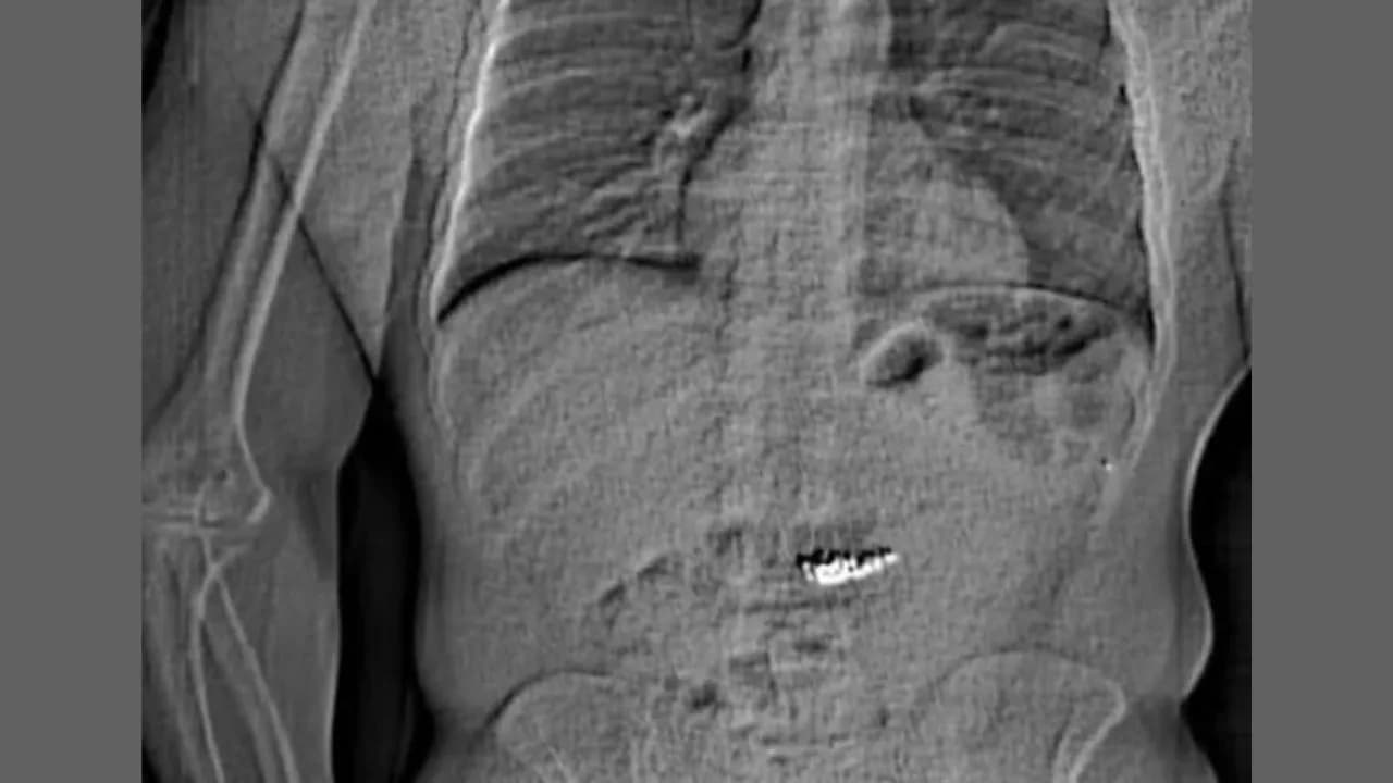 EUA: Ladrão engole joias avaliadas em R$ 4 milhões e é flagrado no raio-X