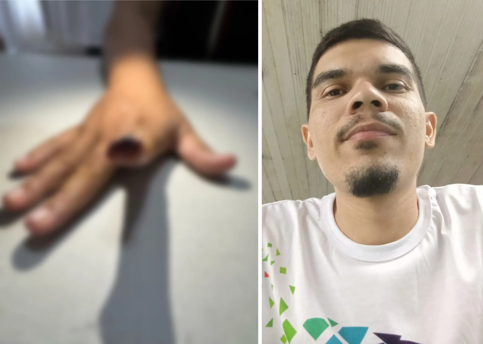 IMAGENS FORTES: Mulher tem dedo decepado por mordida do companheiro durante crise de ciúmes em Manaus