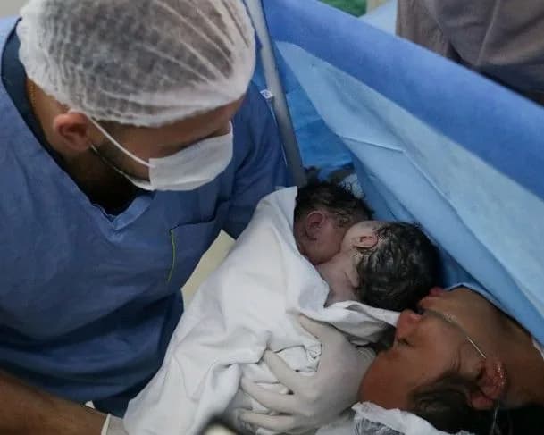 Jovem dá à luz gêmeas siamesas em maternidade do Amazonas