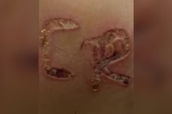 Homem marca iniciais do nome dele nas costas da esposa com ferro quente em SP