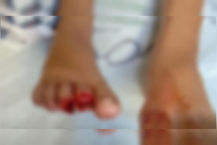 Criança de 9 anos perde dedos durante ataque de piranhas em Goiás