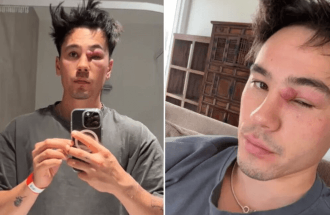 Influenciador confunde cisto com espinha e passa por duas cirurgias de emergência na Austrália