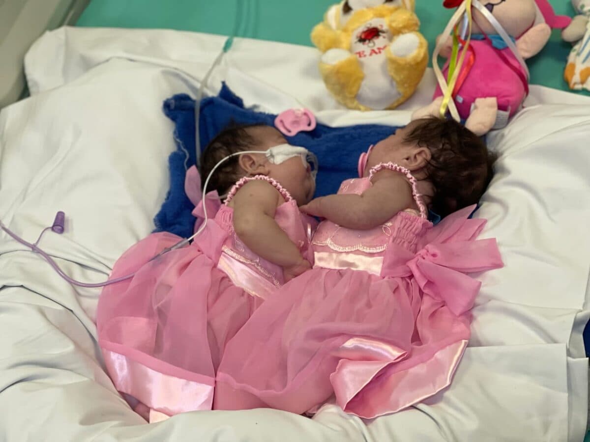 Gêmeas siamesas do Amazonas recebem alta da UTI após cirurgia de separação em Goiás