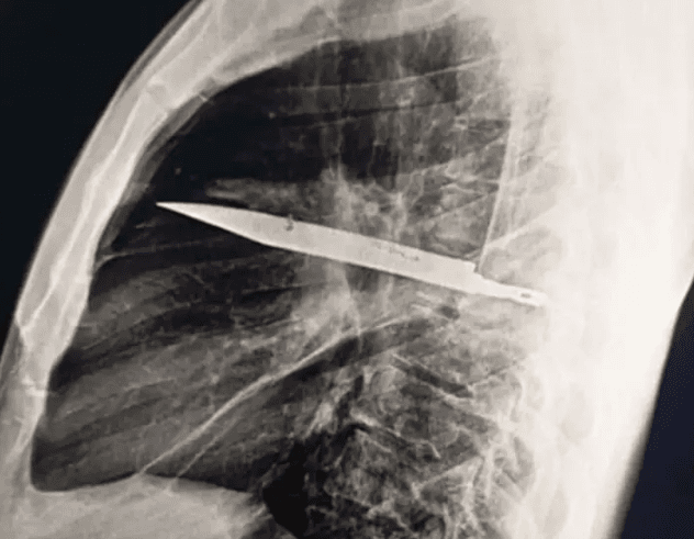 Homem descobre faca alojada no peito por 8 anos após secreção incomum