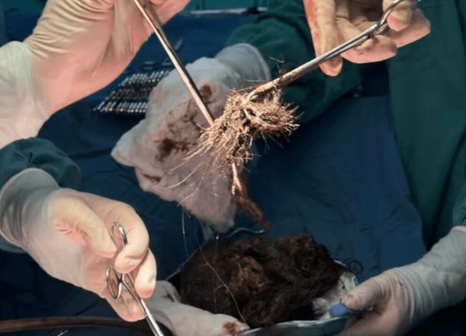 Adolescente de 15 anos tem bola de cabelo de 2 quilos retirada do estômago na China