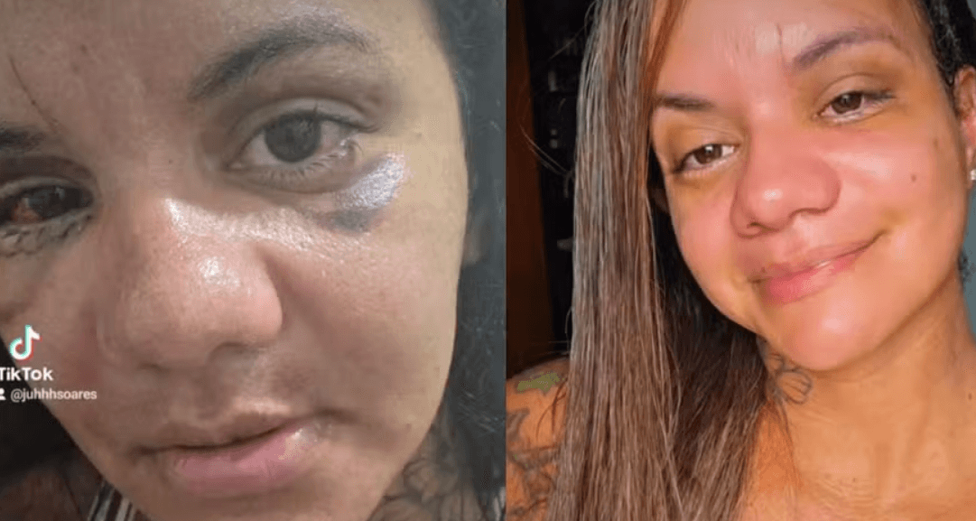 Vítima de tentativa de feminicídio mostra rosto 30 dias após levar 61 socos do ex-namorado