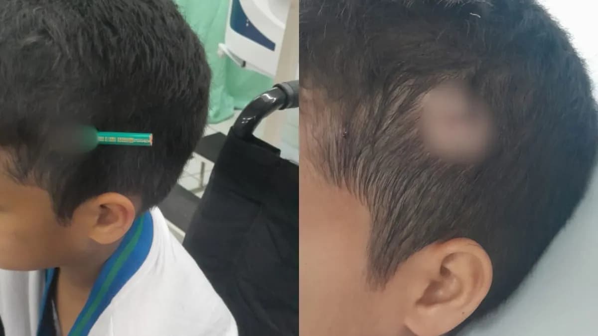 Criança de 9 anos tem lápis cravado na cabeça após briga em escola no litoral paulista