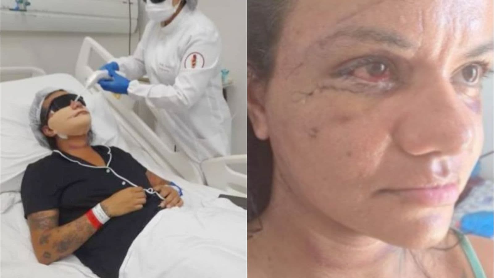 Mulher agredida por ex-jogador de basquete em elevador mostra rosto pela primeira vez após cirurgia; veja