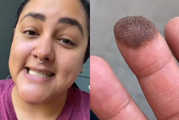 Mulher viraliza ao contar que precisa depilar dedo após enxerto da virilha