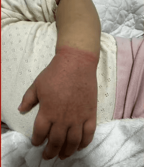 Elástico de cabelo quase faz menina de 2 anos perder o braço em Manaus