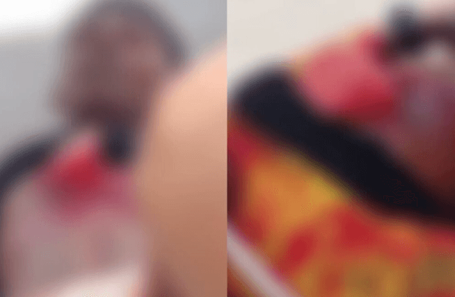 Motociclista tem parte do pulmão exposta em colisão no MA