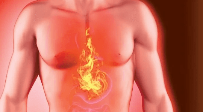 O que provoca azia? Veja o que é verdade, o que é mito e como tratar corretamente