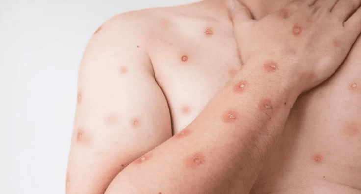 Brasil registra 47 casos de Mpox em 2026, aponta Ministério da Saúde