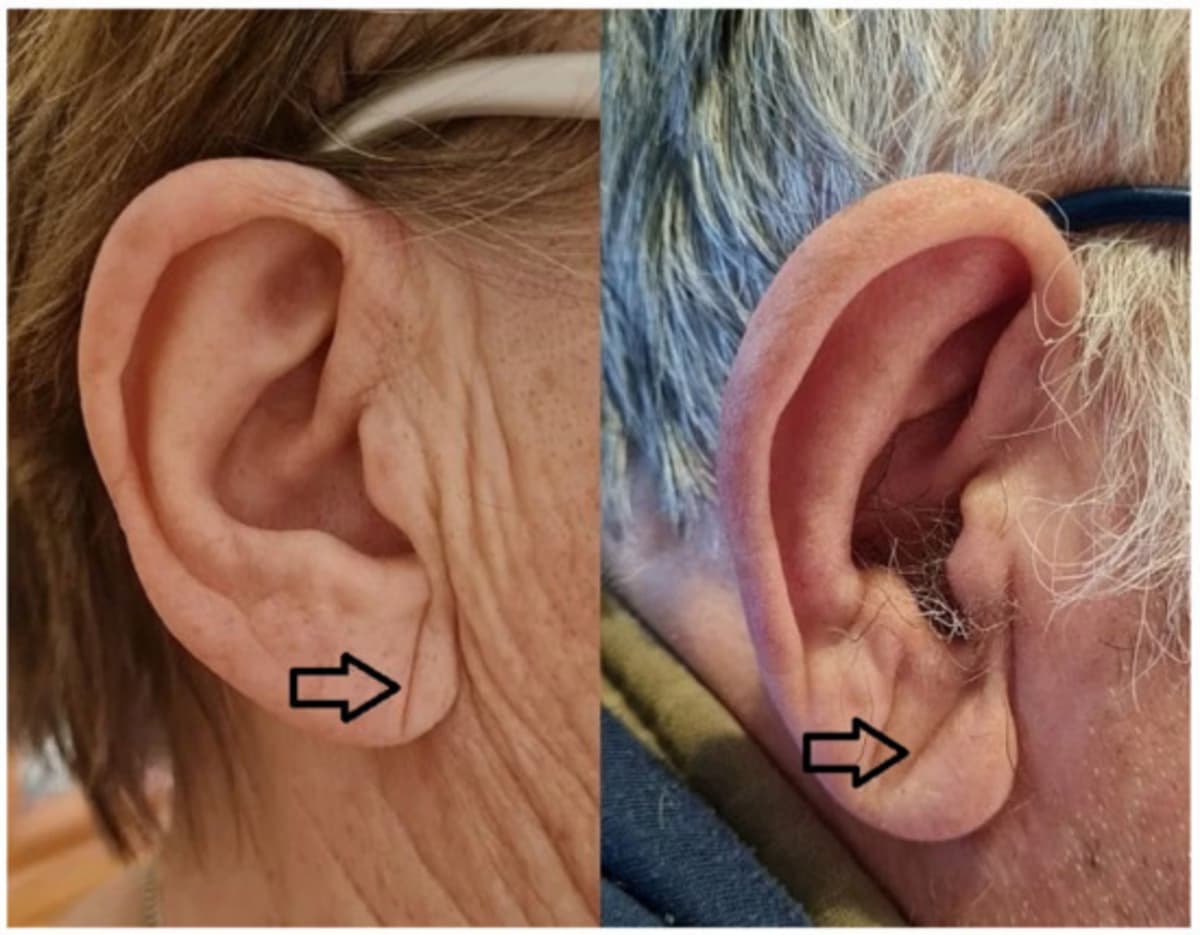 Dobra na orelha pode indicar risco cardíaco? Entenda o que é o Sinal de Frank