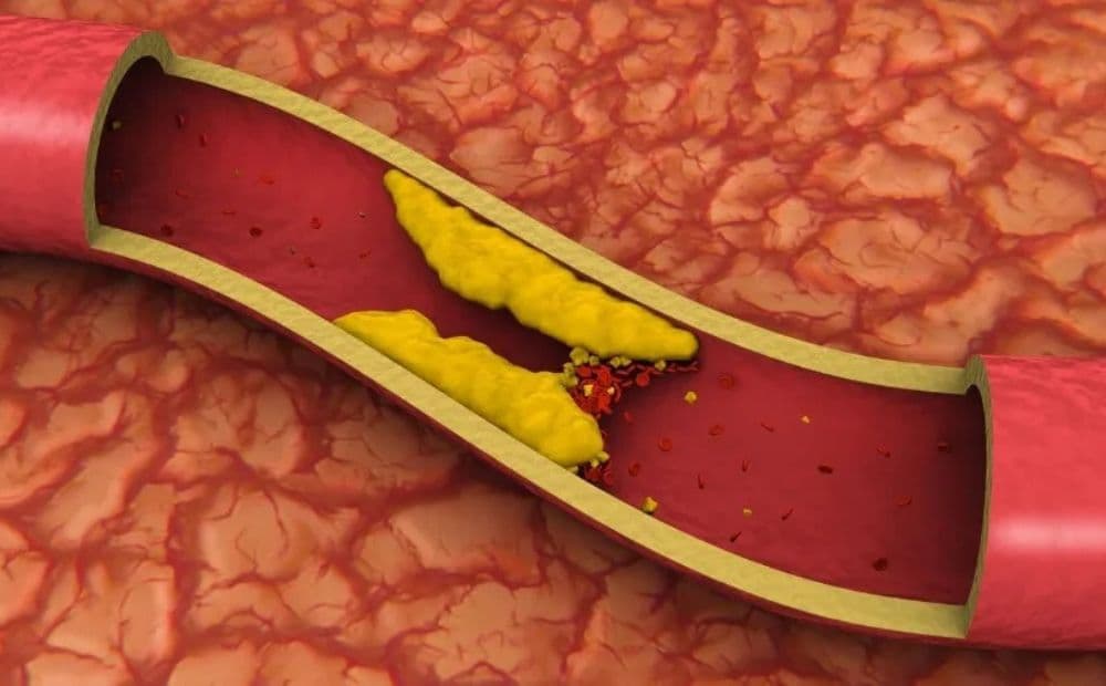 Triglicerídeos altos: entenda o que são e quais alimentos ajudam a controlar os níveis
