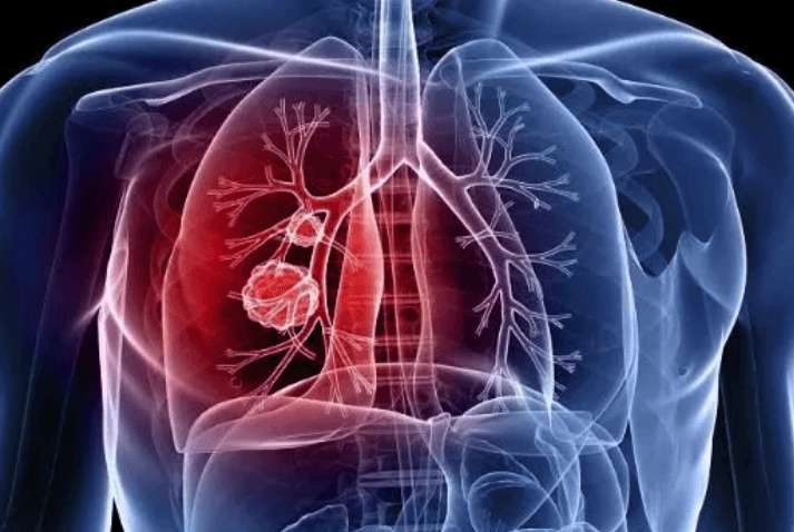 Governo cria grupo para desenvolver novo teste portátil contra a tuberculose