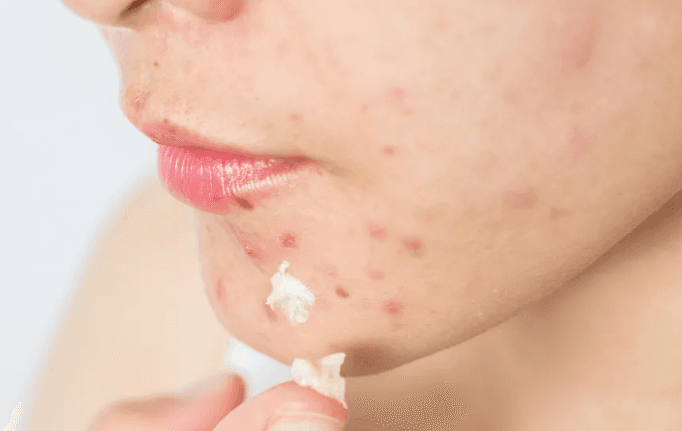 Jovens usam TikTok para buscar informações sobre acne