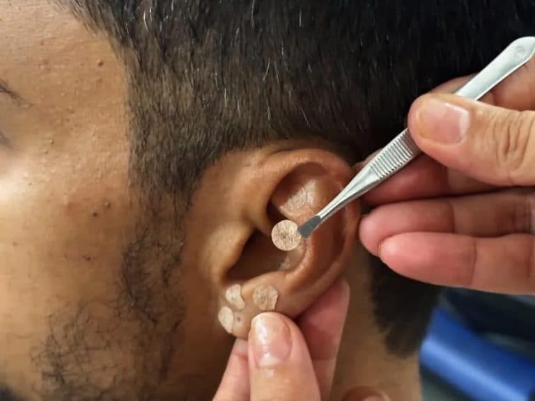 Quer parar de fumar? Palmas oferece tratamento gratuito com apoio profissional e auriculoterapia